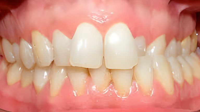 Cross bite teeth, a problem clear aligners can treat
