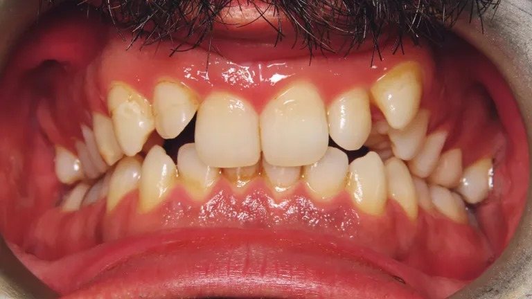 Crowding teeth, a problem clear aligners can treat