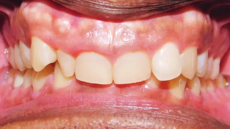 Deep bite teeth, a problem clear aligners can treat