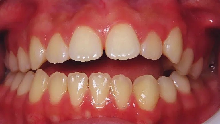 Open bite teeth, a problem clear aligners can treat