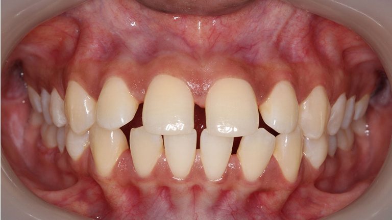 Spacing teeth, a problem clear aligners can treat