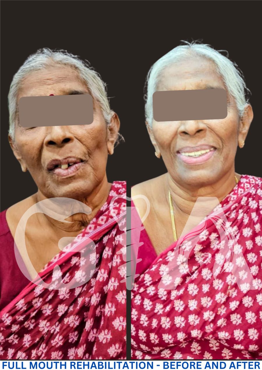 Full mouth rehabilitation, before and after, GIA Clinics Vijayawada
