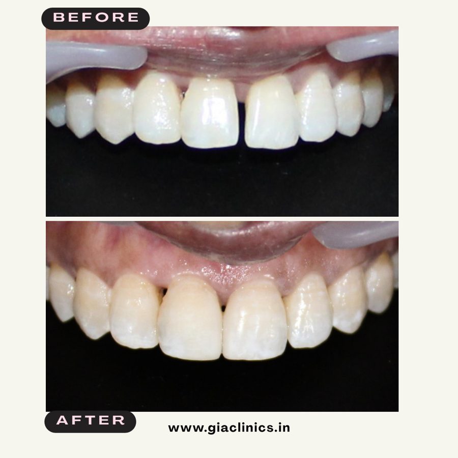 Gap between front teeth closed, before and after, GIA Clinics Vijayawada