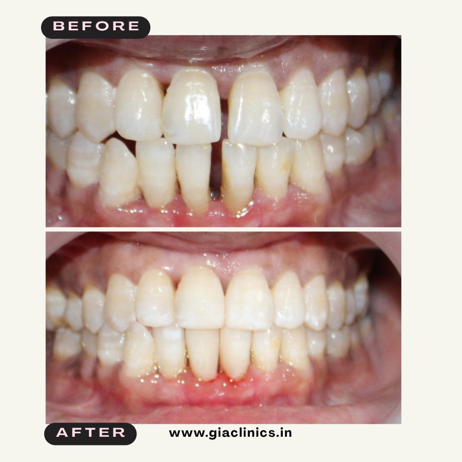 Spacing between teeth closed, before and after, GIA Clinics Vijayawada