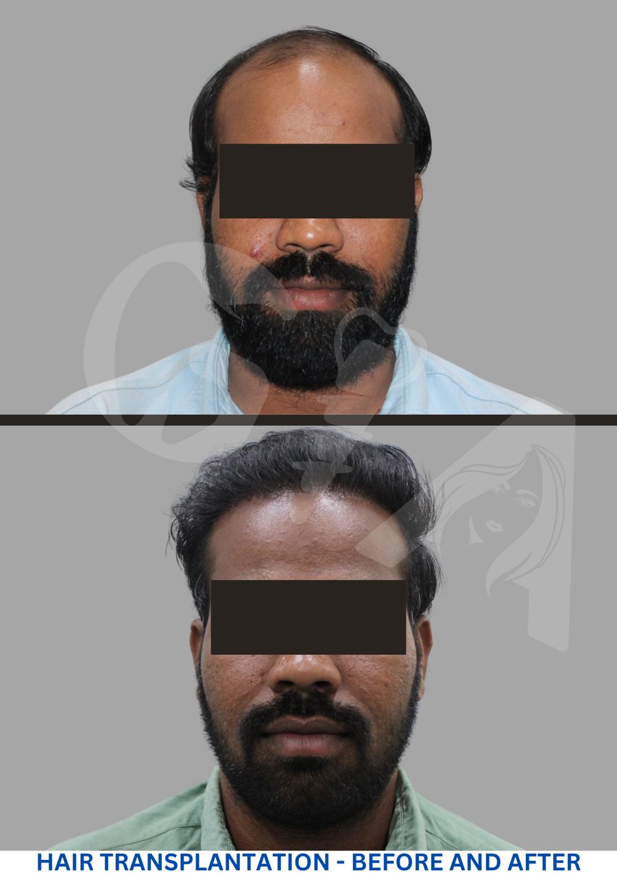 Hair transplant, before and after, GIA Clinics Vijayawada