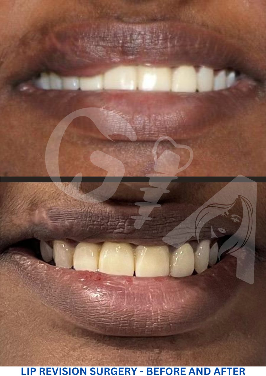 Lip revision surgery, before and after, GIA Clinics Vijayawada