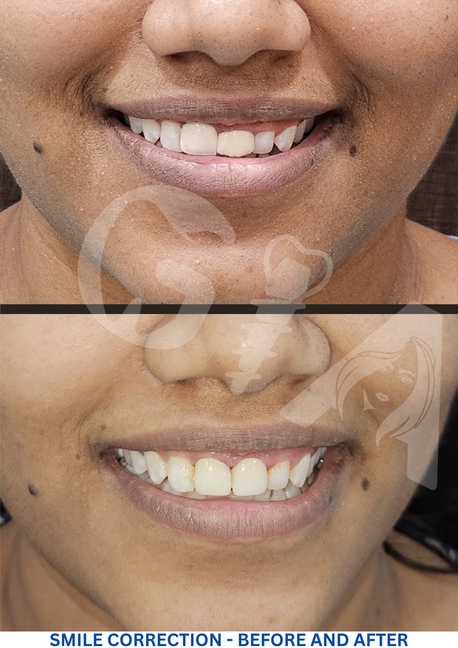 Smile correction, before and after, GIA Clinics Vijayawada