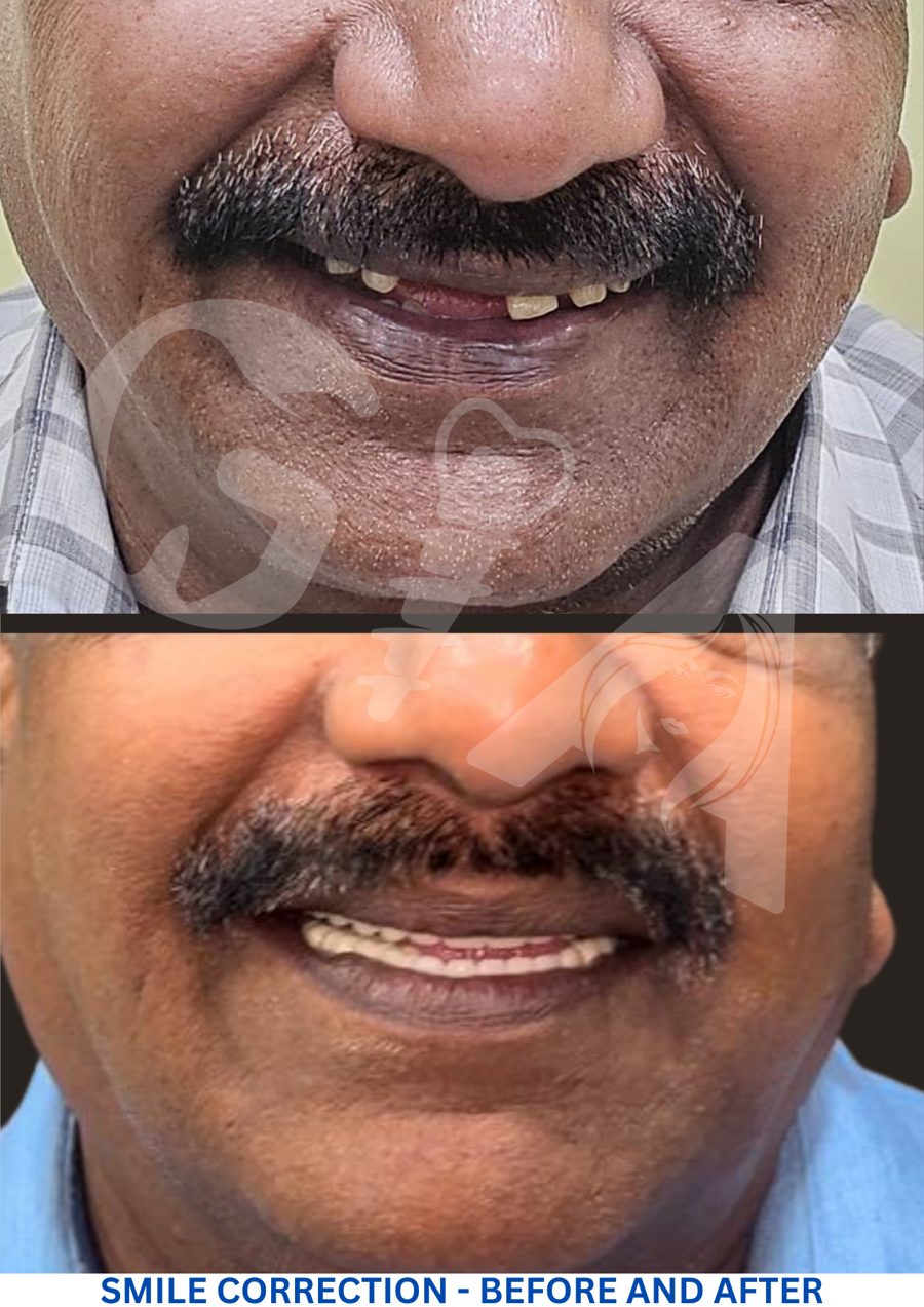 Smile correction with missing teeth replaced, before and after, GIA Clinics Vijayawada